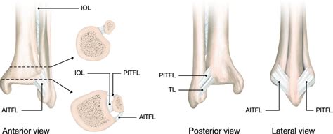 Tibial Plafond