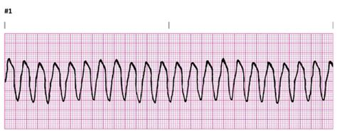 EKG Strips Quiz Flashcards | Quizlet