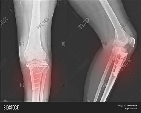 X-ray Knee Joint Image & Photo (Free Trial) | Bigstock