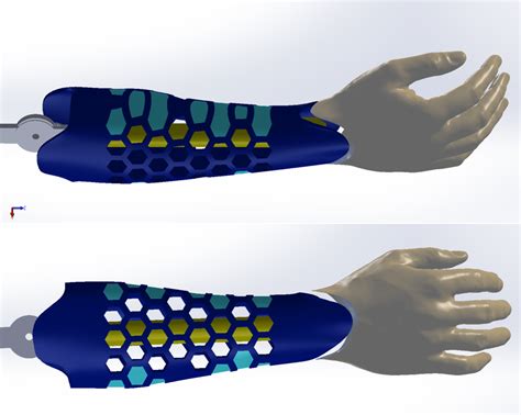 Arm Prosthesis Design for 3D printing I'm working on : r/3Dprinting