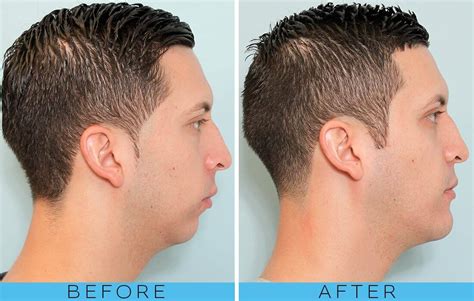 Chin augmentation and Genioplasty | News | Dentagama