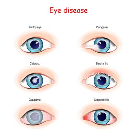 Pinguecula and Pterygium - Henderson Eye Care