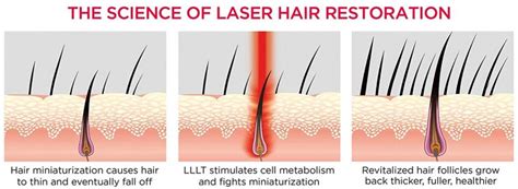 LASER HAIR GROWTH SYSTEM 2019 BEST | Hair Transplant in Turkey