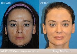 Obagi-Nu-Derm-System-Before-and-After-patient - AestheticA Skin Health ...