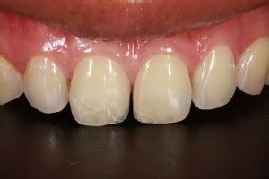 Cracked Tooth Repair - Dr Stone, DDS