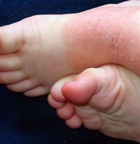 Psoriasis on feet: Symptoms, causes, and treatment