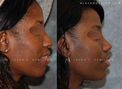 African American Rhinoplasty Los Angeles Black Nose Surgery