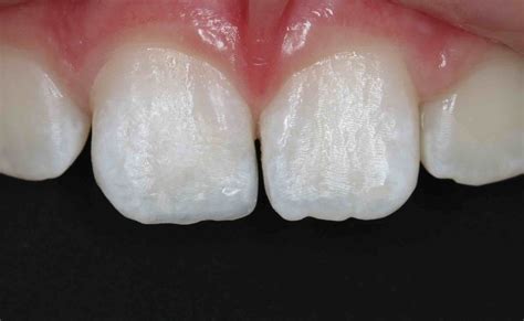 White Fillings Before and After photos - Front Tooth Composite Fillings