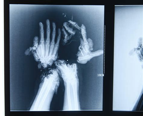 Gonzagas broken hand X-Ray | Sherdog Forums | UFC, MMA & Boxing Discussion