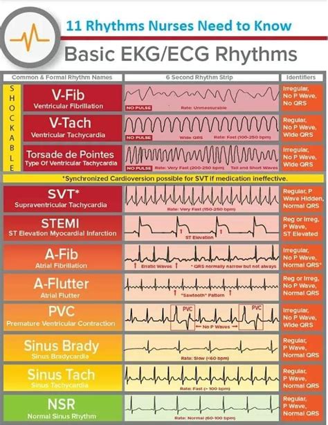 Ecg Abnormalities Chart: Understanding The Heart Health Indicators Of ...