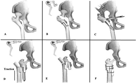 A Cutting of femoral head and planning initial osteotomy in desired ...