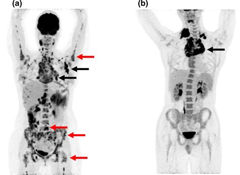 Lymphoma Stage 4 Cancer Pet Scan : Current Status Of Pet Ct In The ...