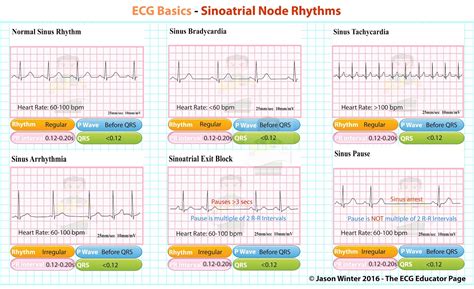 ECG Educator Blog : Sinoatrial Node rhythms