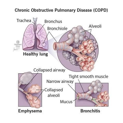 COPD: Causes, Symptoms, Diagnosis, Treatment & Prevention