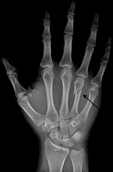 Hand Fractures