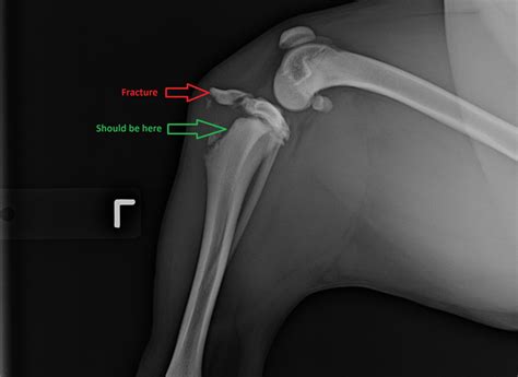 Are X-rays to diagnose an ACL tear a waste of money? | Dr Phil Zeltzman ...