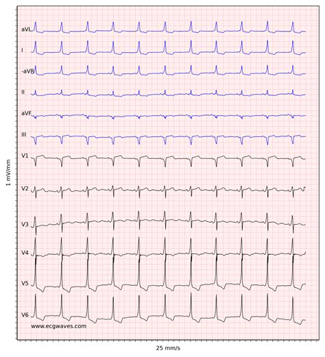 Pre-excitation, Atrioventricular Reentrant (Reentry) Tachycardia (AVRT ...