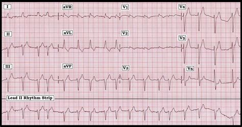 12 lead ecg practice strips - PeterPender3's blog