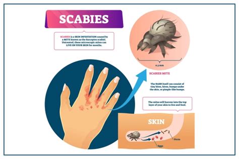 What Is Scabies? Symptoms, Causes, Diagnosis, Treatment,, 45% OFF