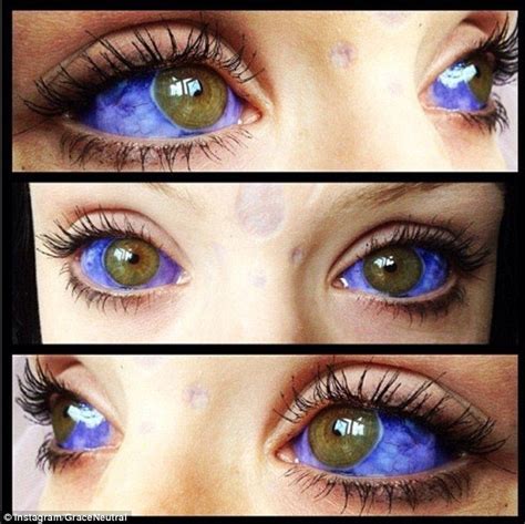 Grace had blue ink injected under the sclera with an ultra fine needle ...