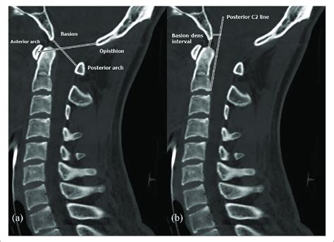 Spect Ct Scan Cervical Spine Ct Scan Machine | Images and Photos finder