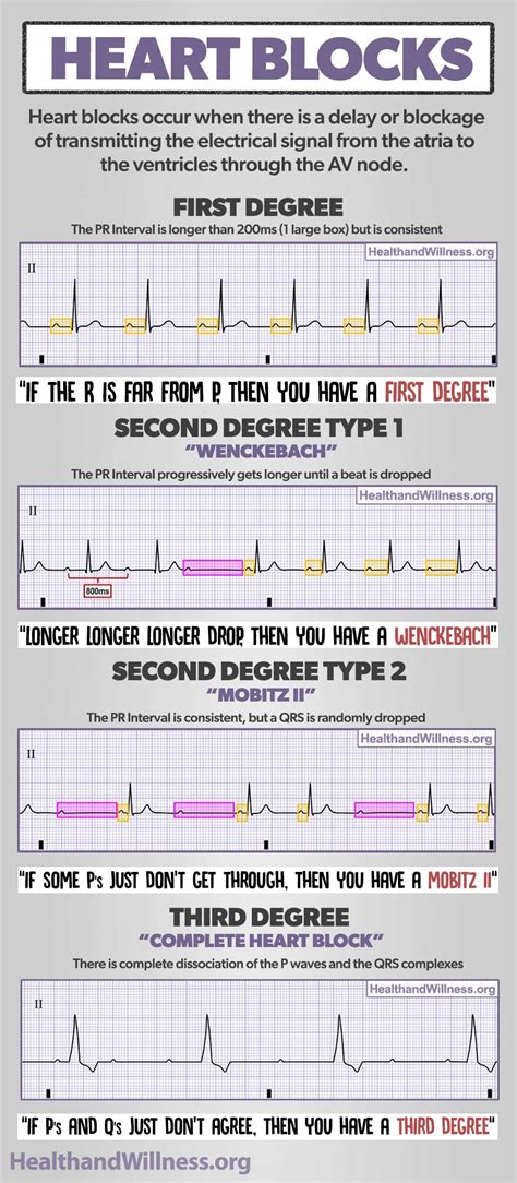 How to Read an EKG Rhythm Strip | Health And Willness