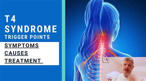 T4 Syndrome - Trigger Point of the Week - YouTube