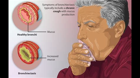 Bronchiectasis | Definition, Causes, Signs and Symptoms, Investigation ...