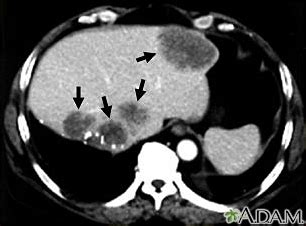 Abdominal CT scan Information | Mount Sinai - New York