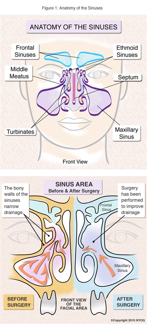 Sinus Anatomy: Check Out This Helpful Diagram - NY Sinus Center