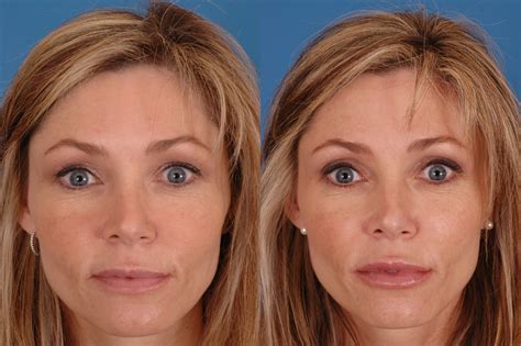 dc filler – Dallas Advanced Facial Plastic Surgery Center