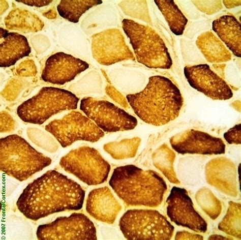 Cytochrome Oxidase staining - Example of pathological findings