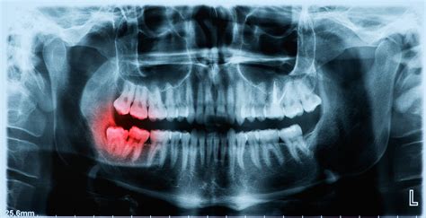 Panoramic x-ray image of teeth and mouth with wisdom teeth | Parkview ...