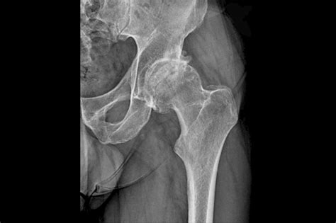 Recognizing and Diagnosing Avascular Necrosis of the Hip in Primary ...