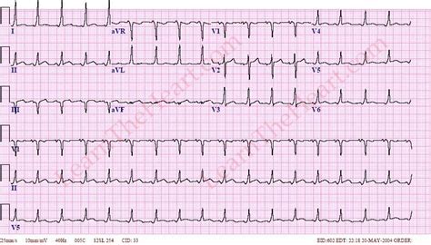 Wolff-Parkinson-White (WPW) ECG (Example 1) | Learn the Heart