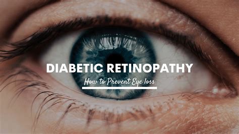 Diabetic Retinopathy - Causes, Signs, And Treatment. - Chadderton Opticians