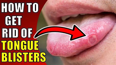 How To Get Rid Of Tongue Blisters - Staybite11