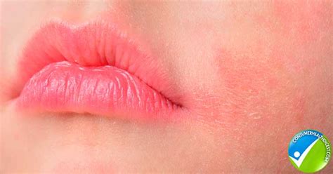 Itchy Burning Lips: 7 Remedies to Try at Home