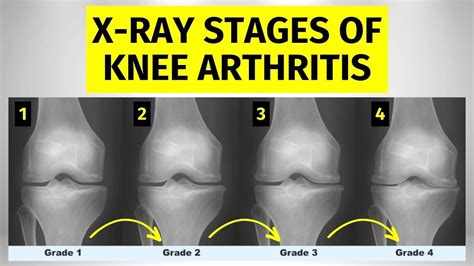 X-ray Stages Of Knee Arthritis