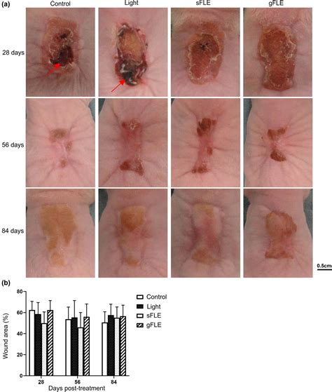 Healing Process Of A Skin Graft at Anthony Farrow blog