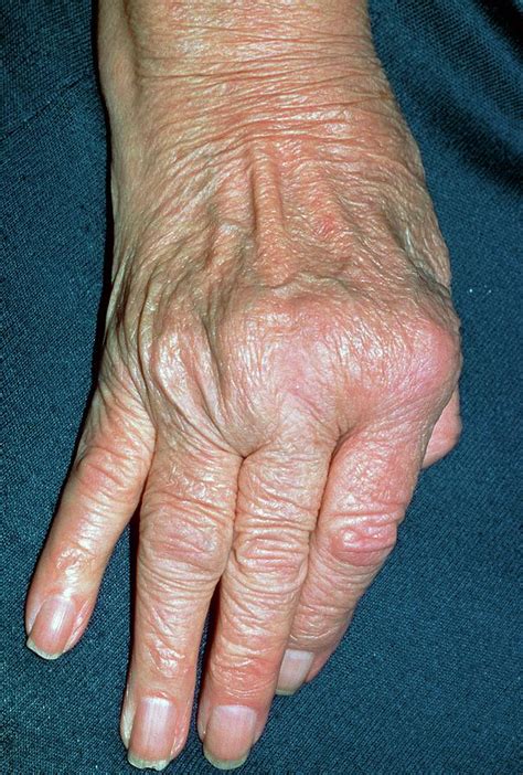 Rheumatoid Arthritis Of Hand With Ulnar Deviation Photograph by Science ...