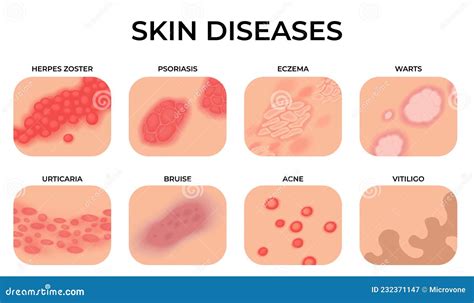 Skin Disease. Different Diseases, Epidermis Surface with Eczema ...