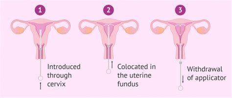 Application of IUD