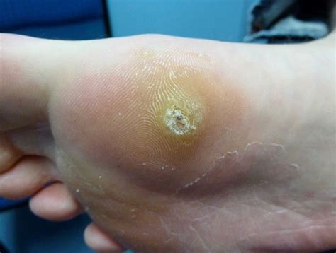 Plantar Warts Symptoms, Causes, Diagnosis and Treatment - Natural ...