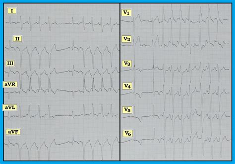 ECG Interpretation: ECG Blog #151 (WCT - VT - SVT - AV Dissociation ...