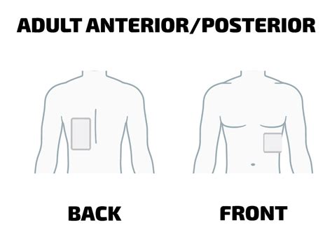 Infant AED Pads: Everything You Need To Know | Heartsmart.com