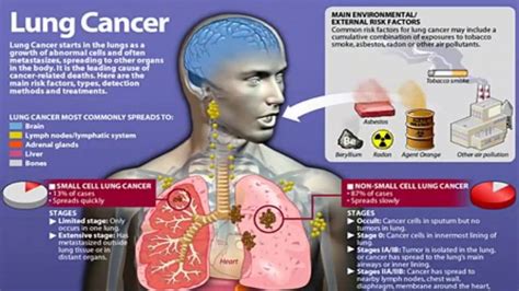 Asbestos Lung Cancer - YouTube