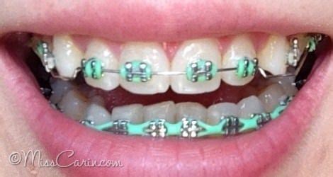 Pin on BRACES