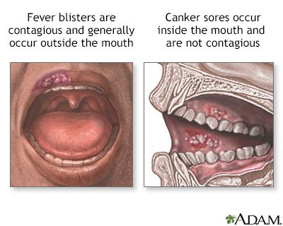 Mouth sores Information | Mount Sinai - New York