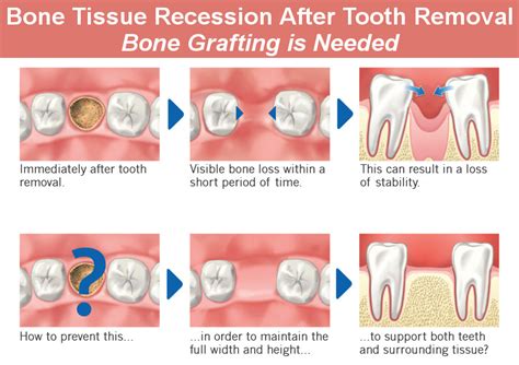 Dentist Glendale: Bone Grafting Types, How and Why Is It Done - Smile ...